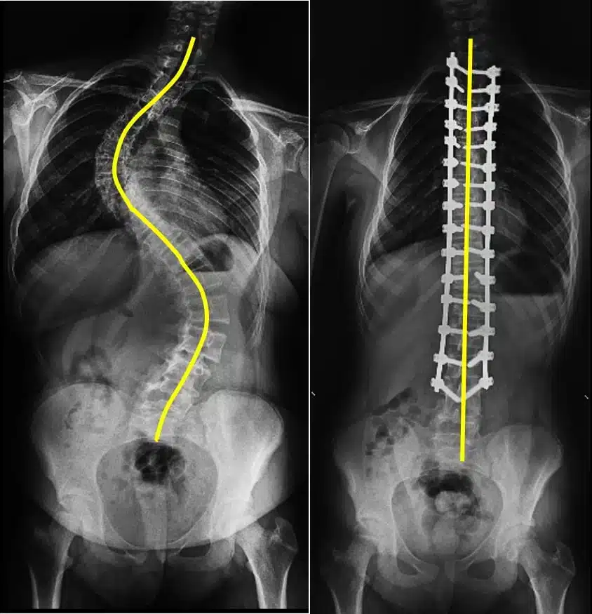 Some Details of Scoliosis Surgery • Assoc.Prof.Dr.Mehmet Nuri ERDEM ...